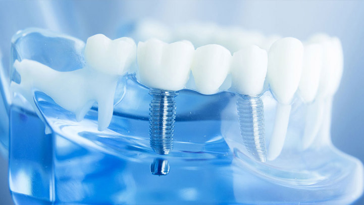 Implant restoration