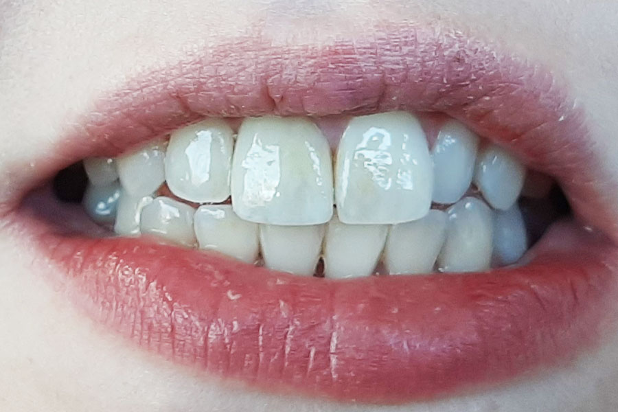 Zirconia work
