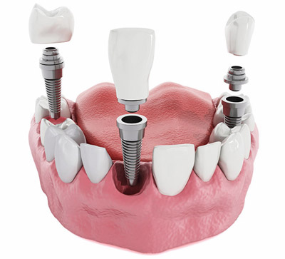 Denture / combined dentures