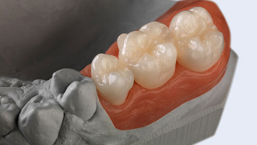 Dental prosthesis repair