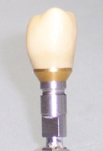 Implantatkrone
