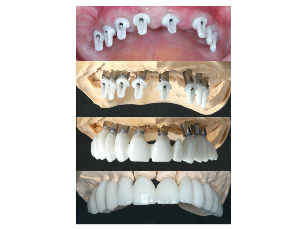 Metal-free fixed denture