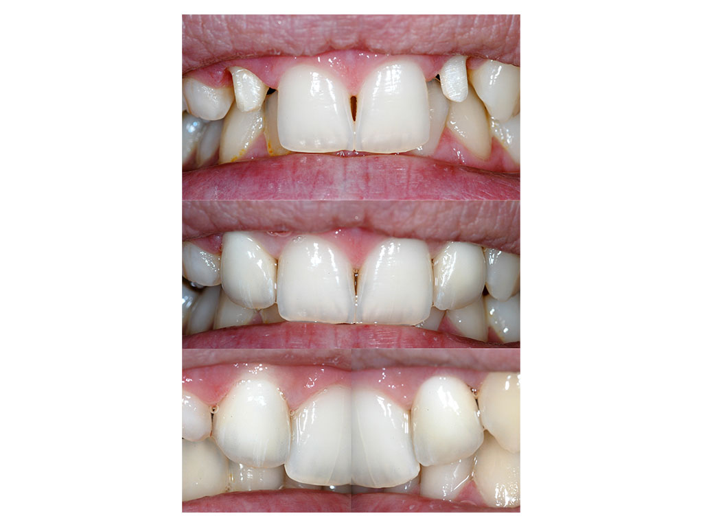 Metal-free fixed denture