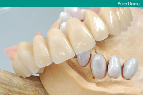 Metal-free dentures