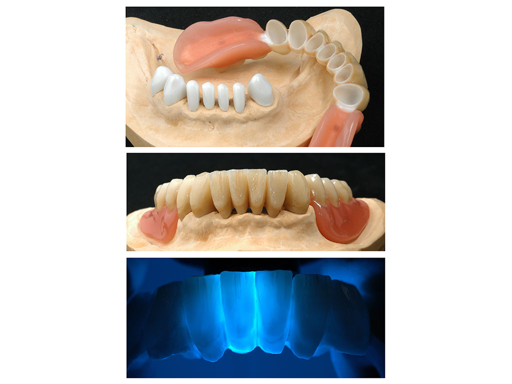 Metal-free removable denture