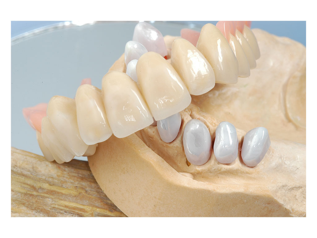 Metal-free removable denture