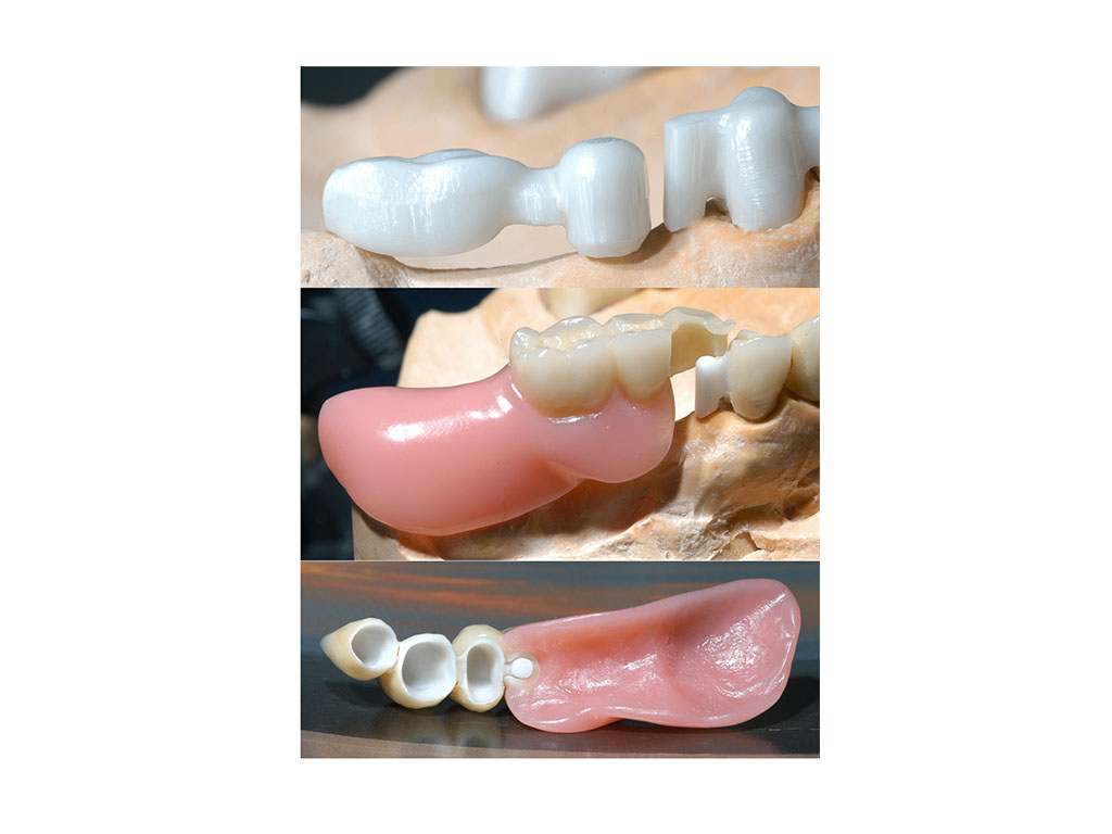 Abutment
