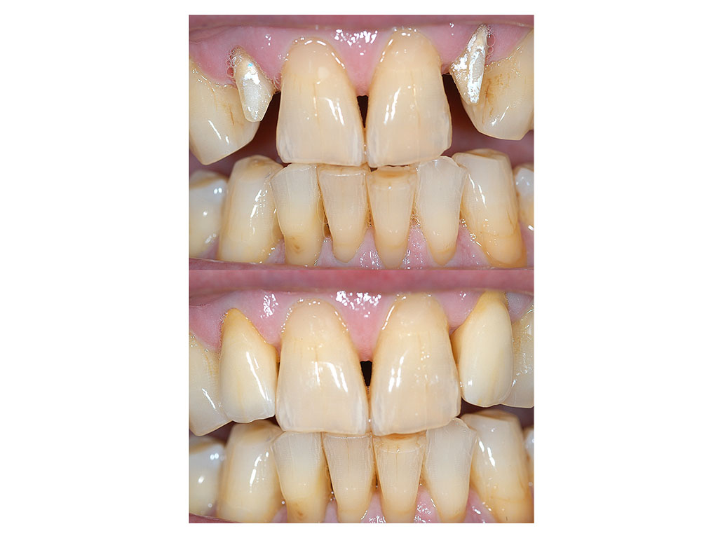Metal-free fixed denture