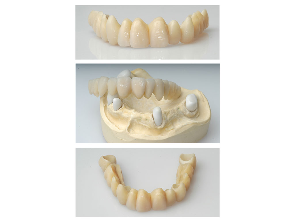 Metal-free removable denture